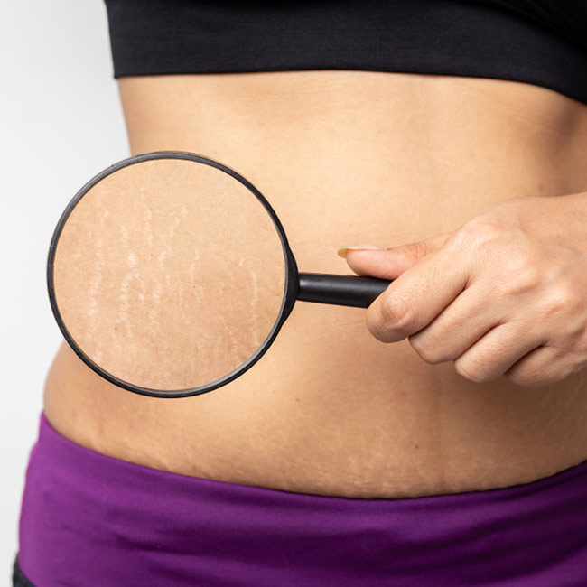 Virker det at eksfoliere strækmærker?