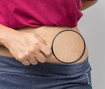 hvorfor får man strækmærker hvorfor får man strækmærker